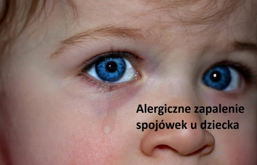 Alergiczne Zapalenie SpojÓwek U Dziecka Jak Rozpoznać Objawy Leczenie 